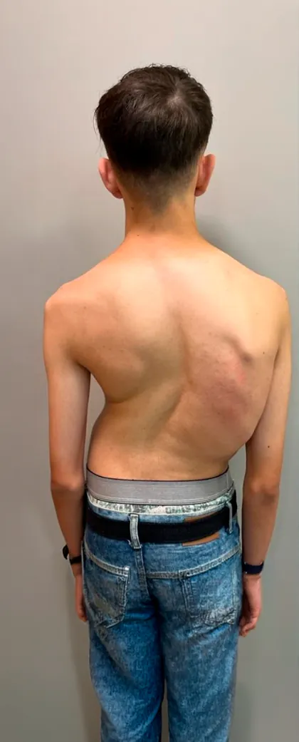 Costas de paciente com escoliose antes da cirurgia