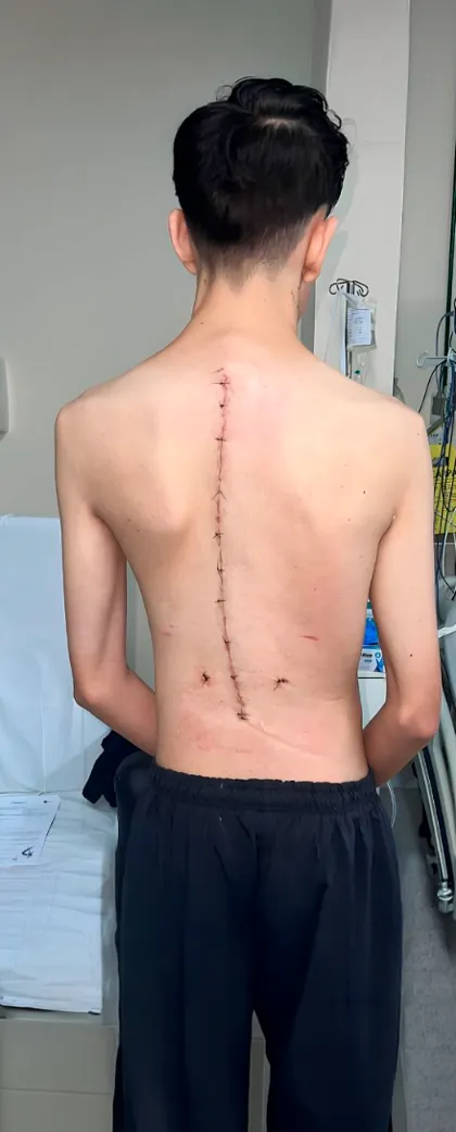 Costas do mesmo paciente após a cirurgia de correção da escoliose